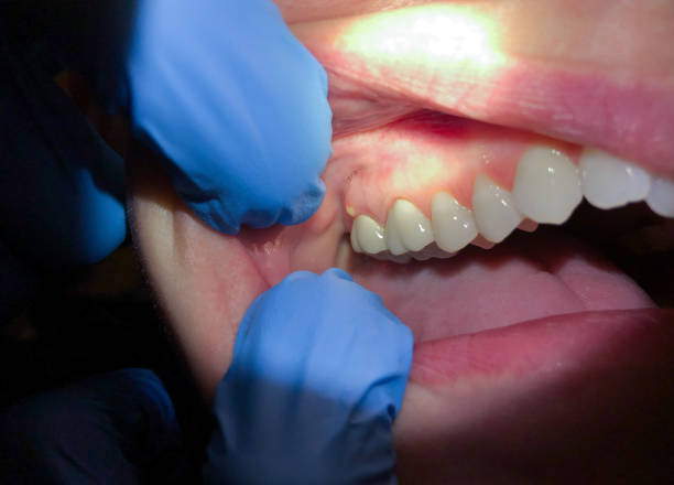 Best Emergency Wisdom Tooth Extraction in Wayne, WV